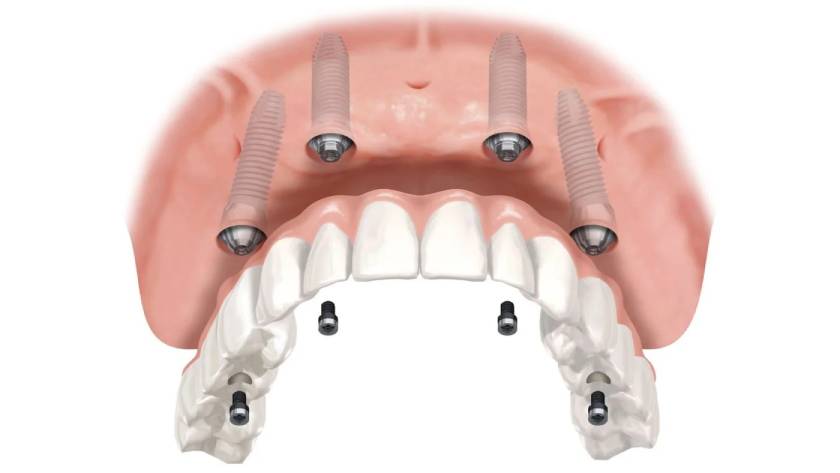 Trồng răng Implant thông thường sử dụng trụ Implant cấy vào xương hàm