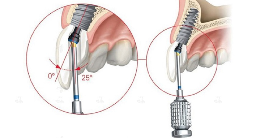 Trụ Implant ảnh hưởng đến thời gian trồng Implant