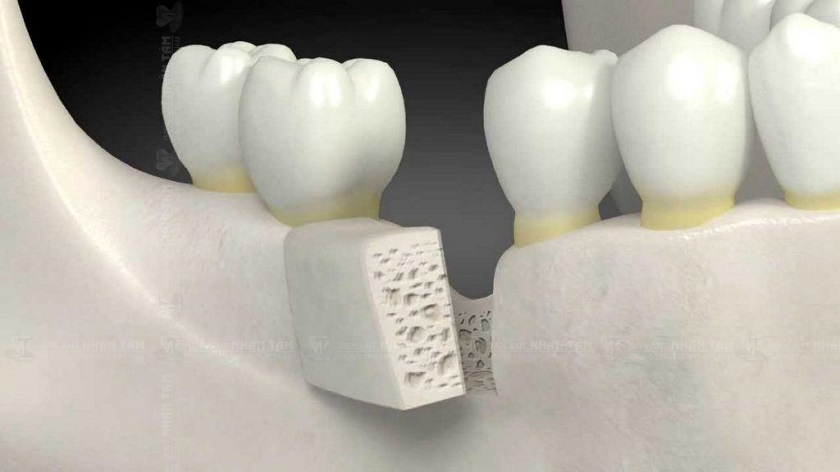 Xương hàm cần đạt tiêu chuẩn để thực hiện Implant tức thì