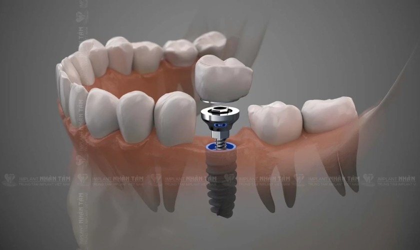 Cắm một trụ Implant thường mất khoảng 10-15 phút