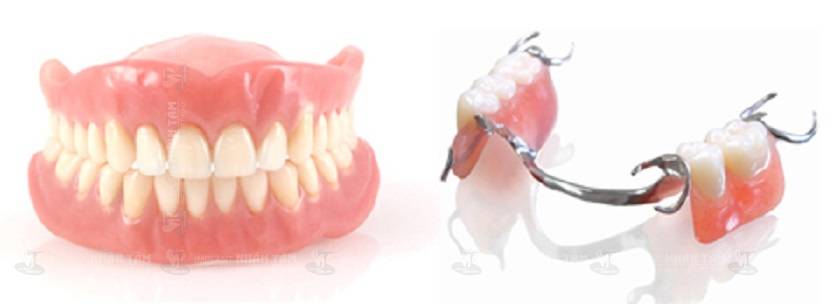 Hàm giả tháo lắp thường được chỉ định cho bệnh nhân không đủ điều kiện cấy ghép răng Implant