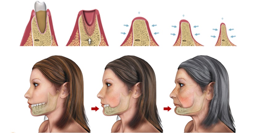 Tiêu xương hàm do mất răng