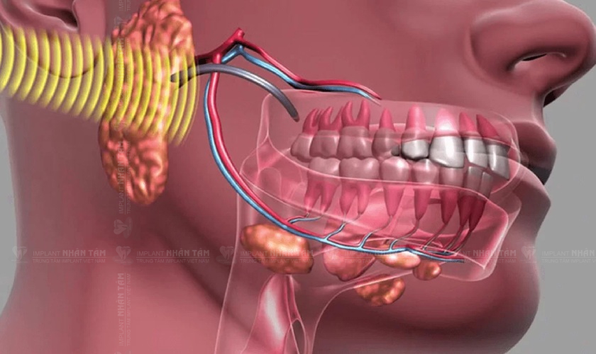 Ung thư vùng hàm mặt là một trong những nguyên nhân gây mất răng