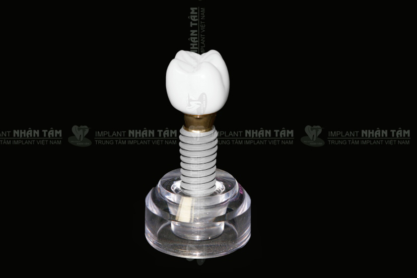 Răng Implant có cả chân răng và thân răng giúp phục hồi ăn nhai hiệu quả và ngăn ngừa tiêu xương hàm