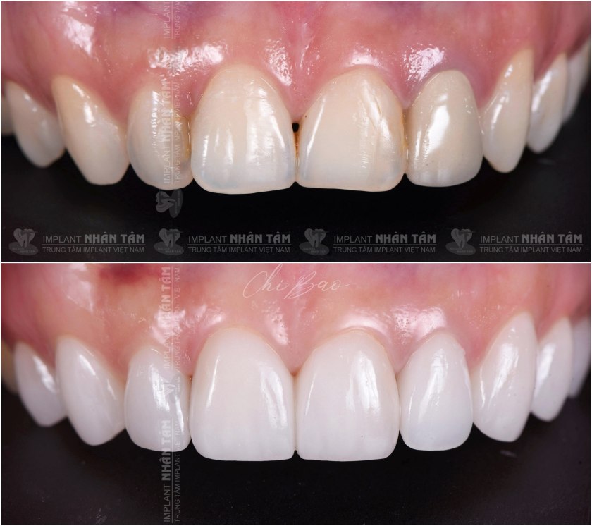 Các ca điều trị của Bác sĩ CKI Trương Chí Bảo Các ca điều trị của Bác sĩ CKI Trương Chí Bảo