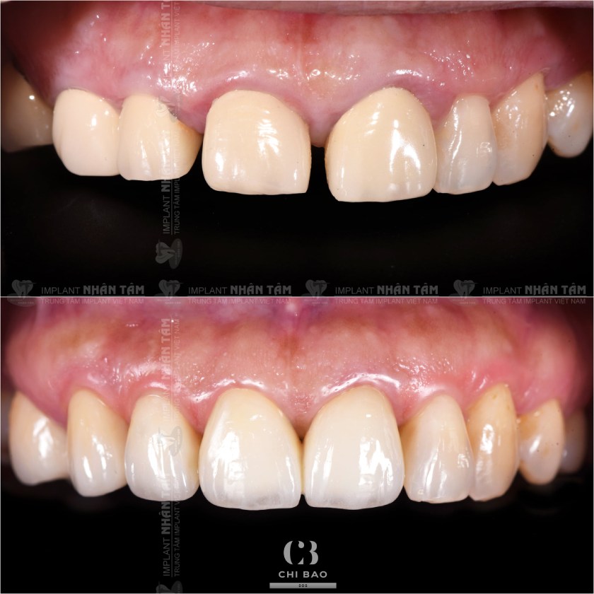 Các ca điều trị của Bác sĩ CKI Trương Chí Bảo Các ca điều trị của Bác sĩ CKI Trương Chí Bảo