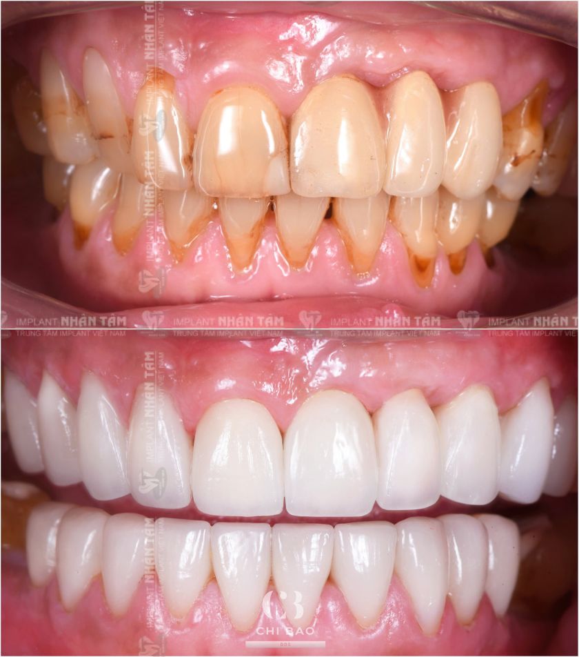Các ca điều trị của Bác sĩ CKI Trương Chí Bảo Các ca điều trị của Bác sĩ CKI Trương Chí Bảo