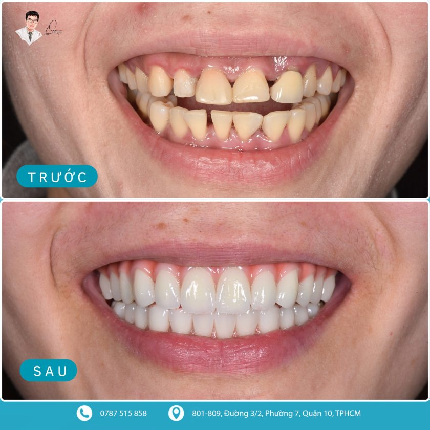 Khách hàng cấy ghép Implant toàn hàm Khách hàng cấy ghép Implant toàn hàm