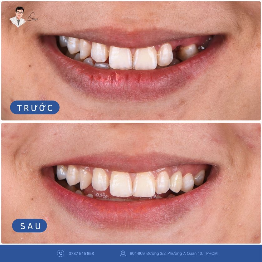 Khách hàng mất 1 răng cửa Khách hàng mất 1 răng cửa