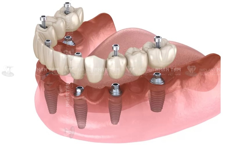 Giá cấy răng Implant toàn hàm sẽ tùy thuộc vào từng khách hàng