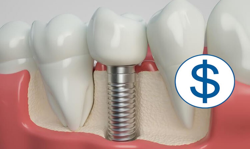 Cấy răng Implant hết bao nhiêu tiền còn tùy thuộc vào nhiều yếu tố