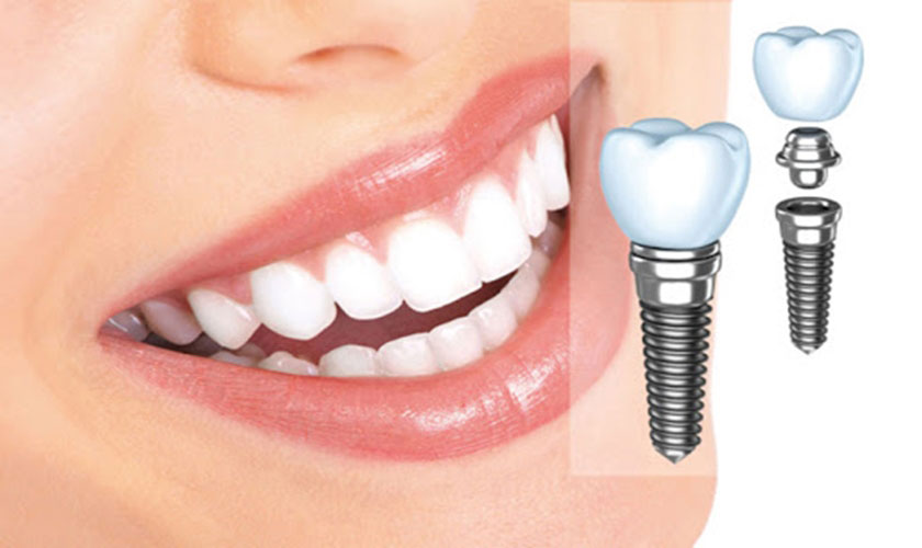 Răng Implant có thể tồn tại vĩnh viễn nếu được chăm sóc tốt