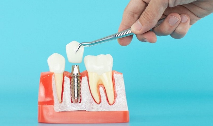 Trồng răng Implant giá bao nhiêu tại TPHCM