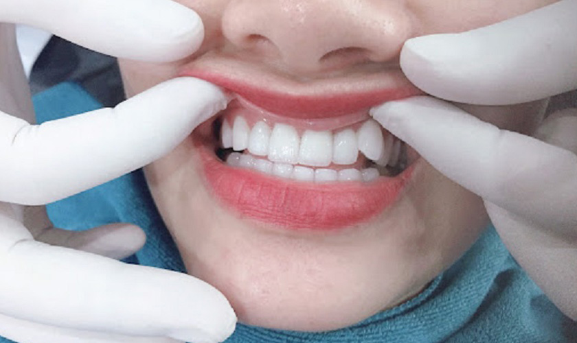 Trồng răng khểnh bằng giải pháp bọc răng sứ thẩm mỹ