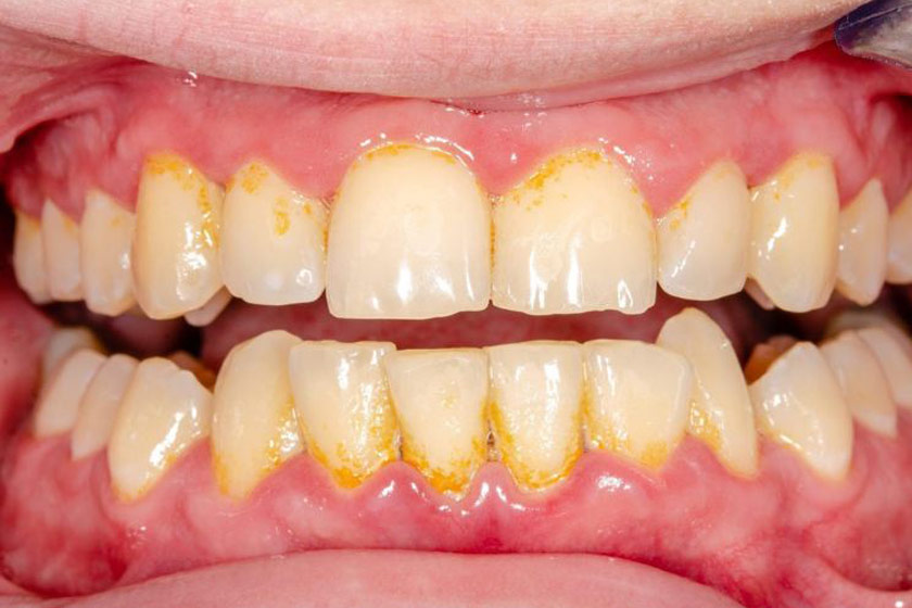 Vôi răng là nguyên nhân dẫn đến tình trạng sưng nướu răng