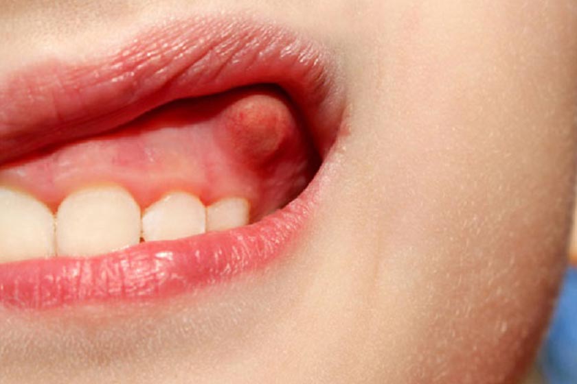Top 5 cách giảm sưng nướu răng tại nhà cần biết