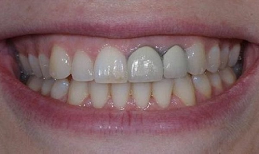 Cầu răng sứ Titan có thể gây vệt đen tại đường viền nướu sau một thời gian sử dụng