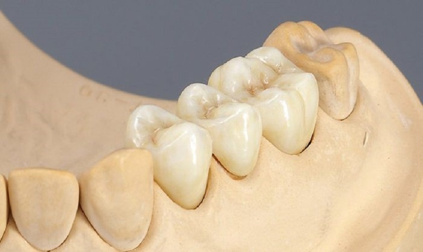 Cầu răng sứ Titan là gì? Có ưu và nhược điểm nào?