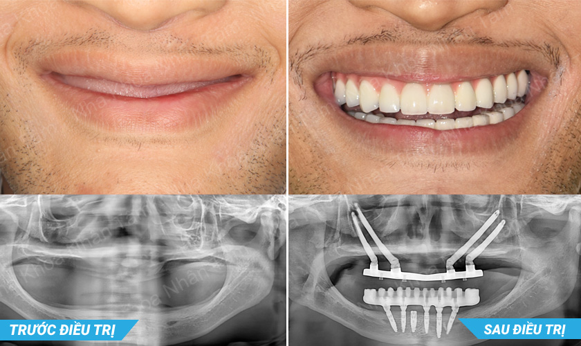 Zygoma Implants giúp khôi phục răng nướu một cách tự nhiên