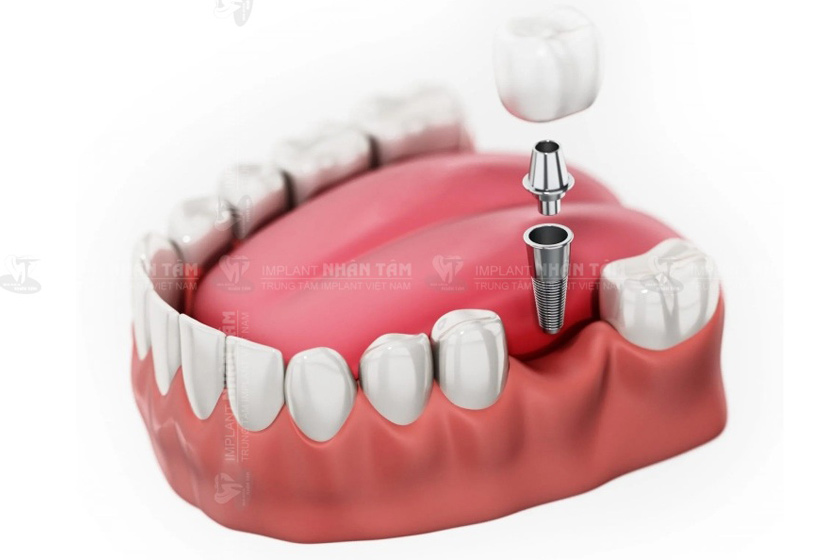 Trồng răng Implant an toàn không ảnh hưởng răng liền kề