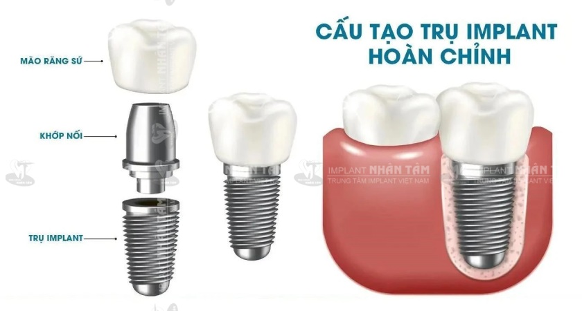 Trồng răng Implant là phương pháp an toàn và không gây ảnh hưởng gì đến sức khoẻ của khách hàng