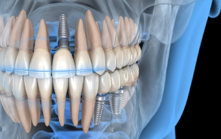 Trụ Implant phải được cấy đúng vị trí và có sự tương quan hài hòa với răng bên cạnh