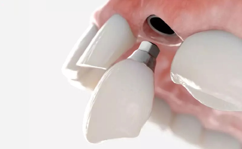 Răng sứ trên Implant phải có màu sắc, hình dáng và các đặc điểm tương đồng với răng thật