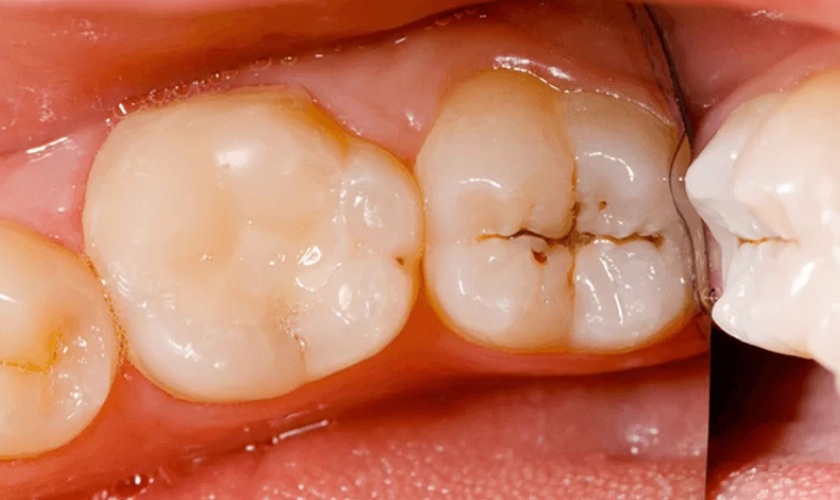 Tình trạng chấm đen ở răng