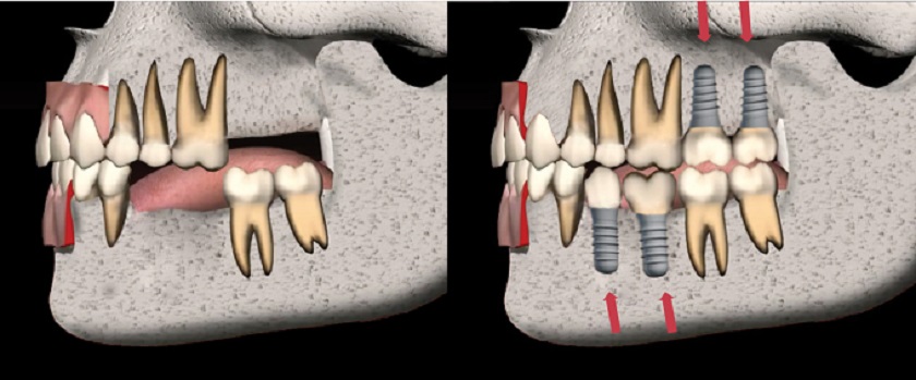 Cấy răng Implant ngăn ngừa được biến chứng tiêu xương do mất răng