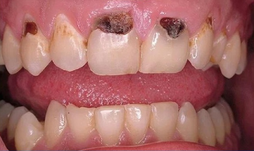 Chân răng bị mục có thể kéo theo nhiều bệnh lý nặng nề khác