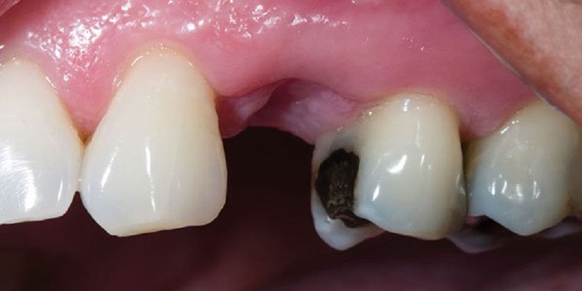 Mất răng vĩnh viễn nếu không phát hiện và chữa trị răng bị mục kịp thời