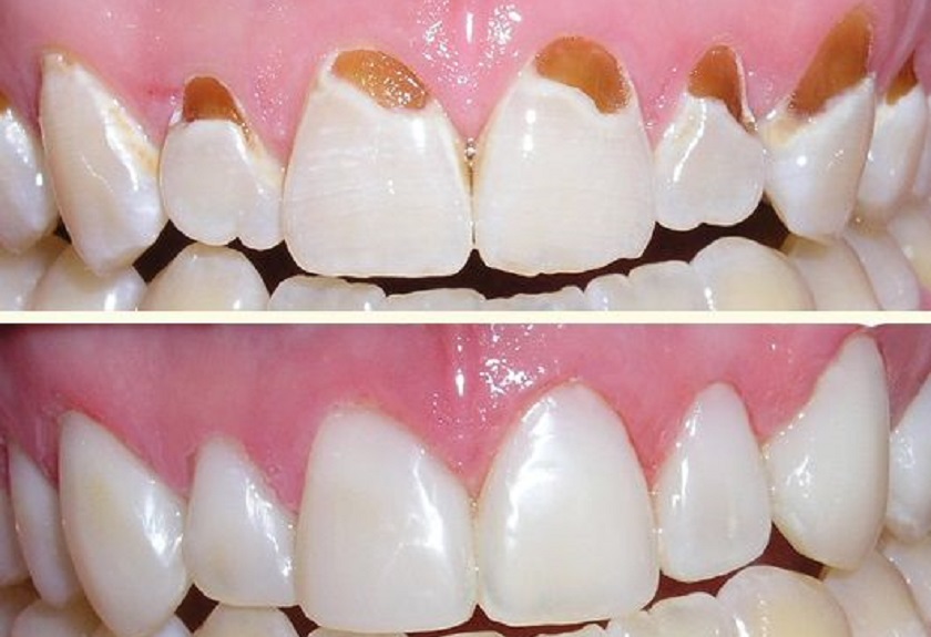 Trám răng – biện pháp điều trị hiệu quả răng bị mục ở mức độ nhẹ