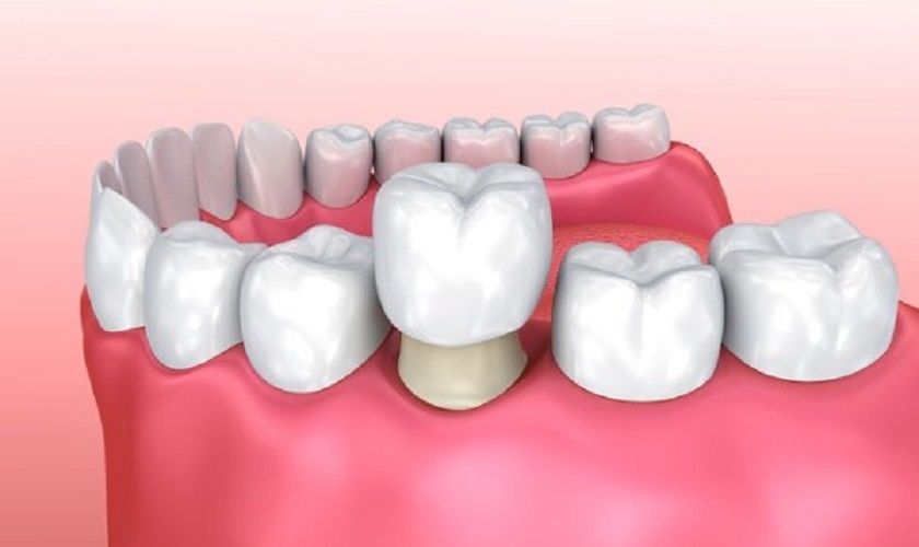 Khắc phục lỗ mục lớn trên răng bằng kỹ thuật bọc răng sứ thẩm mỹ