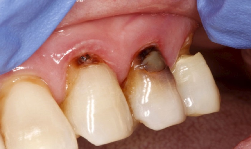 Chân răng bị mục - Nguy cơ gây mất răng vĩnh viễn