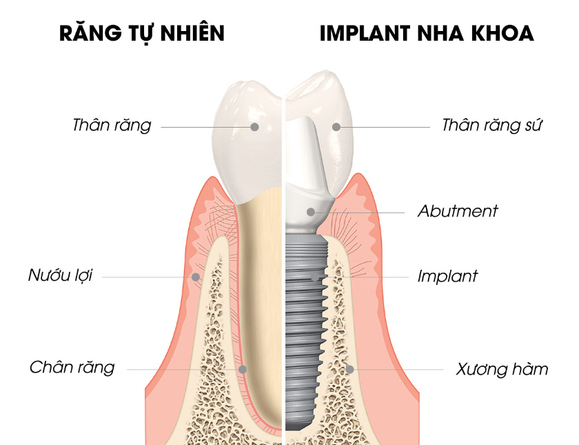 Răng Implant mô phỏng hoàn hảo cấu trúc răng thật
