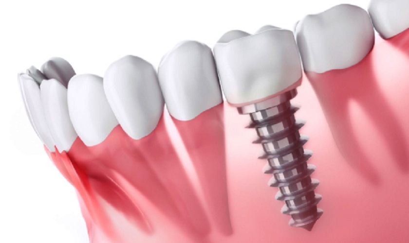 Đặc điểm chân răng thật và chân răng nhân tạo Implant