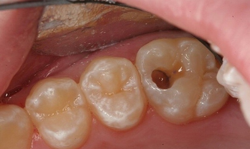Sâu răng – nguyên nhân hàng đầu gây ra viêm tủy răng