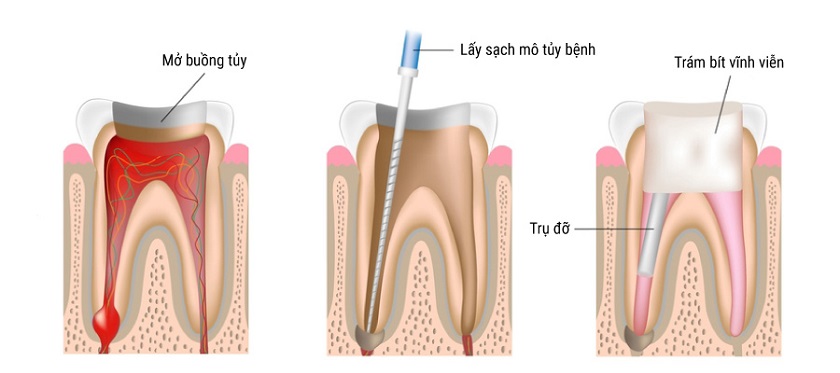 Mở ống tủy và lấy các mô tủy răng đã bị viêm nhiễm