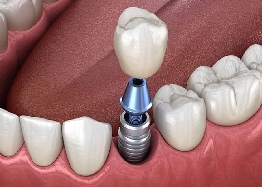 Trồng răng Implant – Giải pháp phục hình toàn diện nhất