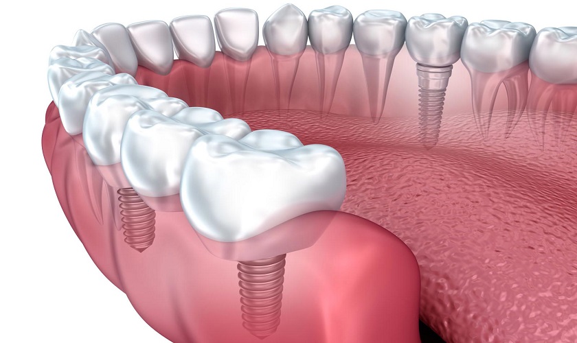 Trồng răng Implant lần 2 có thể không? Hiệu quả như thế nào?