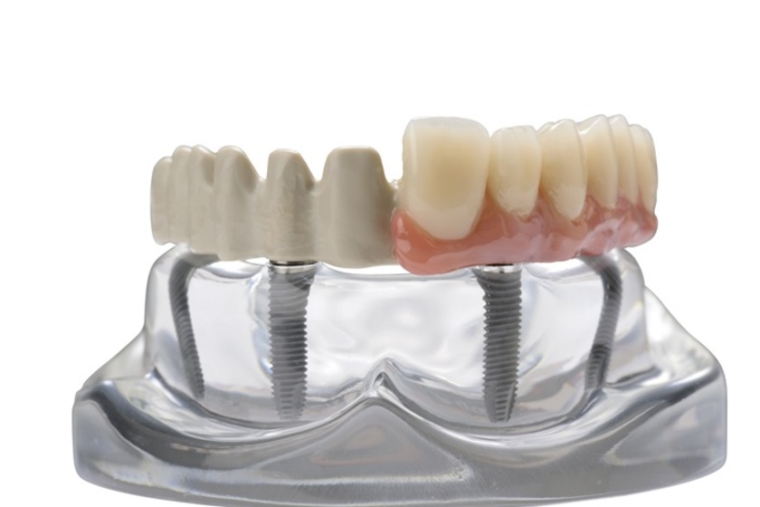 BioHPP là một vật liệu cải tiến và phù hợp để trồng răng Implant