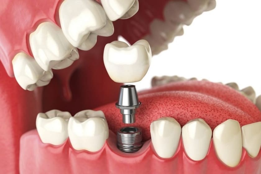 Cấy ghép implant được coi là giải pháp lý tưởng cho các trường hợp mất răng