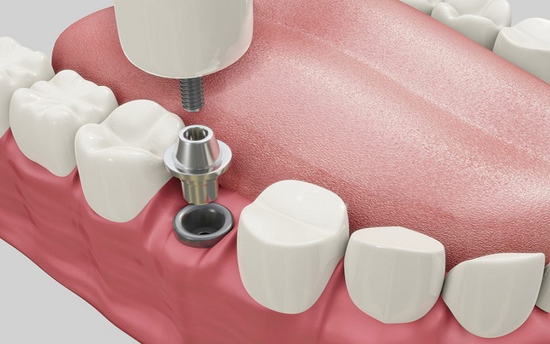 Trồng răng Implant Fast 3D hiệu quả và an toàn