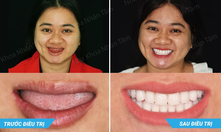Hình ảnh trước và sau khi cấy ghép răng Implant Fast 3D của khách hàng