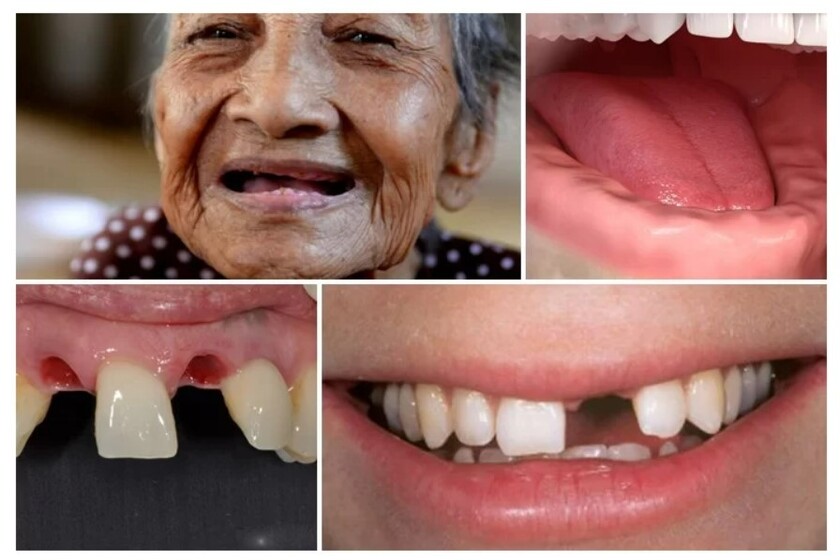 Trồng răng Implant Fast 3D phù hợp với nhiều trường hợp mất răng