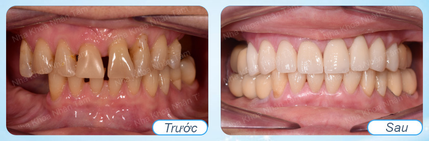 Hình ảnh trước và sau khi cấy ghép răng Implant Fast 3D