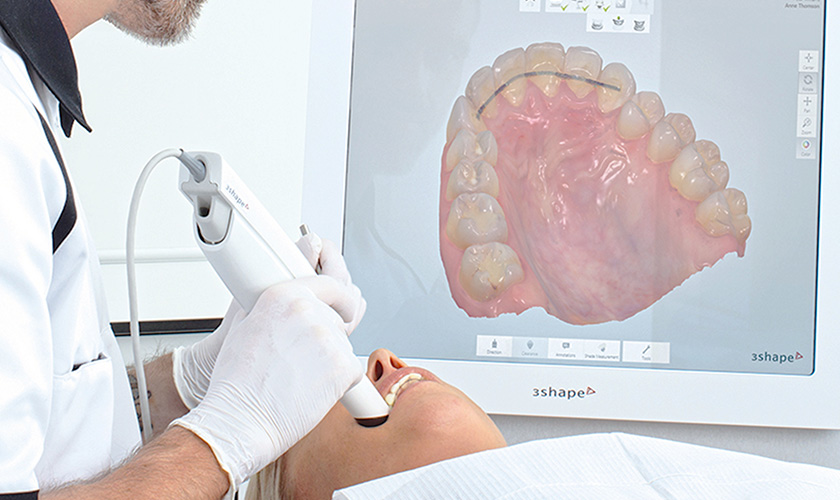 Công nghệ lấy dấu răng kỹ thuật số giúp quá trình lấy dấu răng dễ dàng, tiện lợi và nhanh chóng
