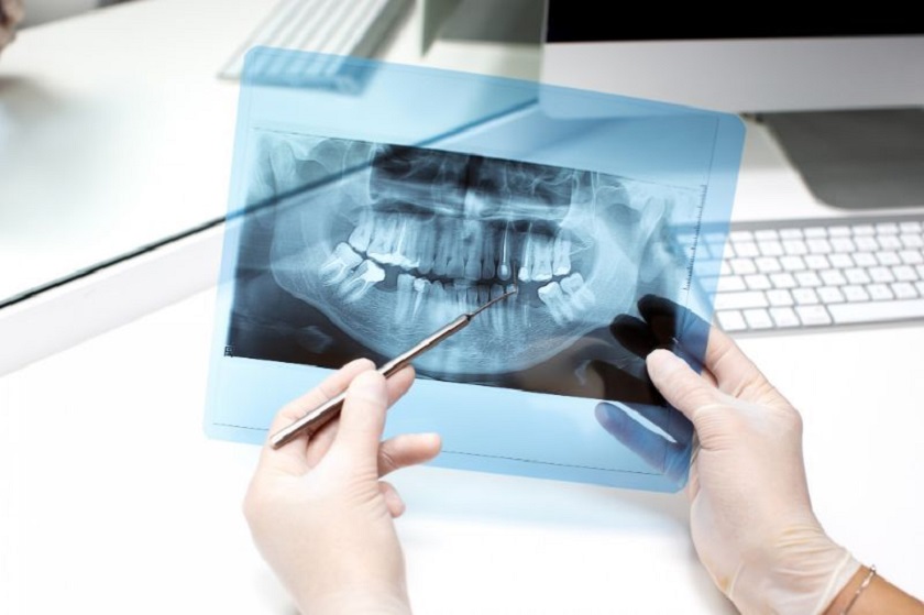 Người loãng xương có thực hiện trồng răng Implant được không?
