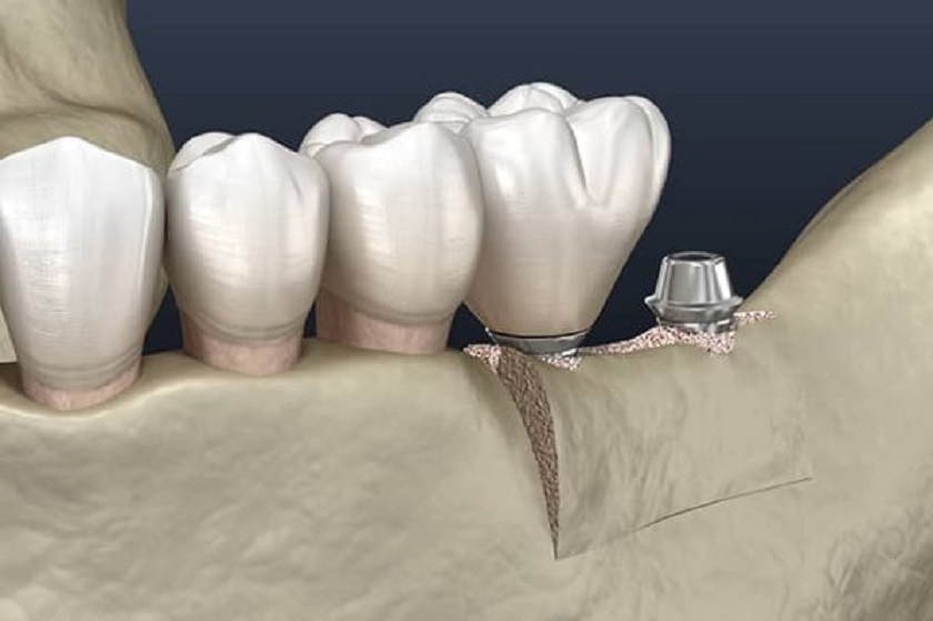 Công nghệ từ tính – Giải pháp trồng răng Implant cho người loãng xương