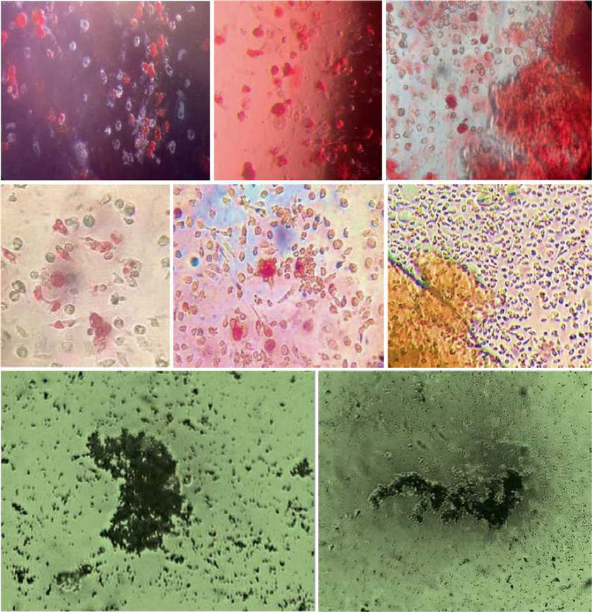 Innovative Scaffold Solution for Bone Regeneration Made of Beta-Tricalcium Phosphate Granules, Autologous Fibrin Fold, and Peripheral Blood Stem Cells